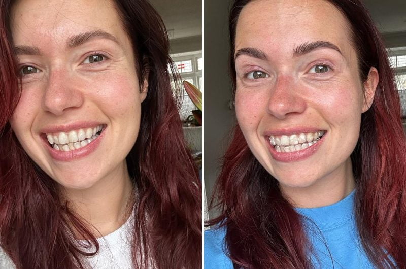 Invisalign: update na 10 weken • Cynthia