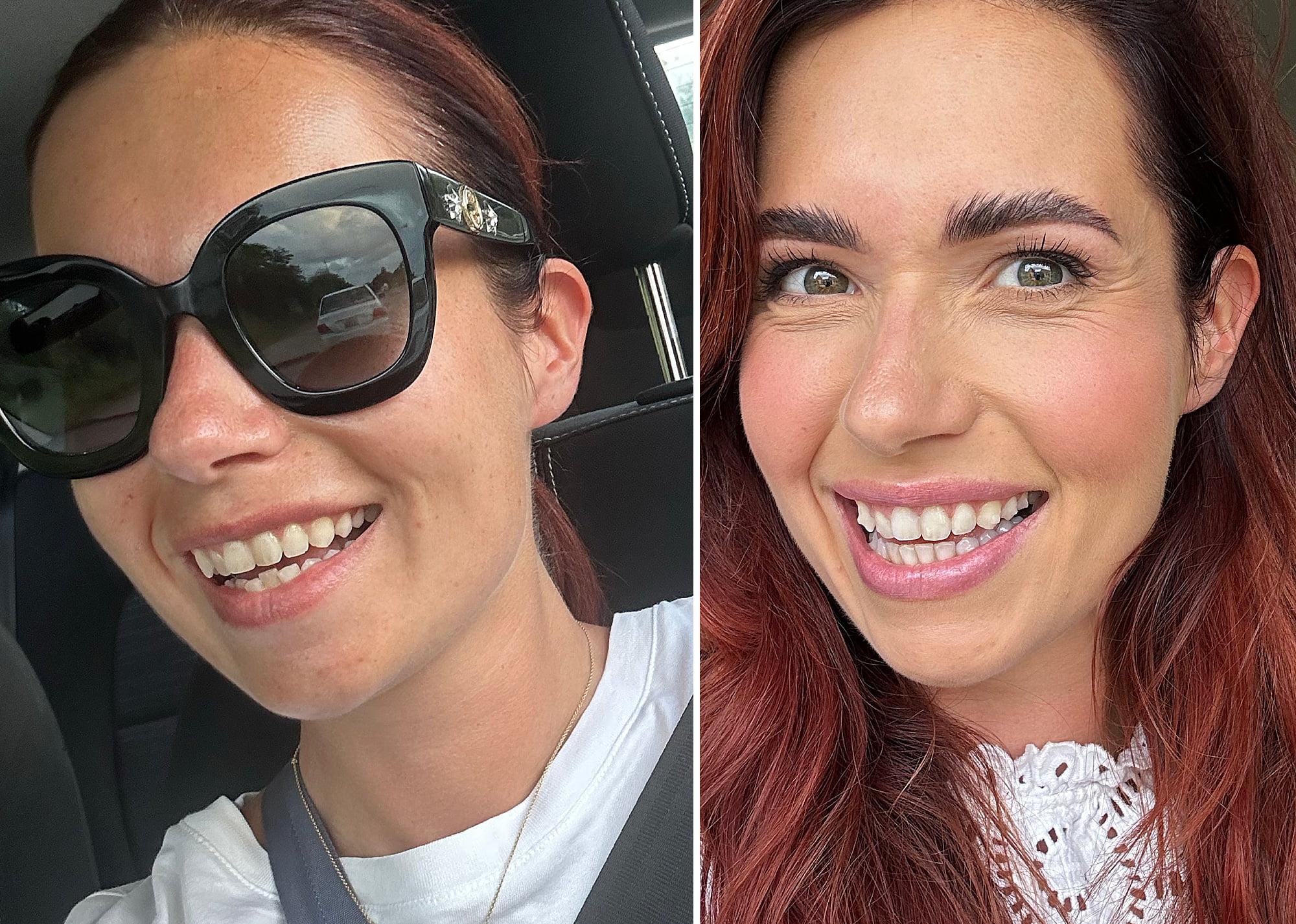 Invisalign na 24 weken • Cynthia