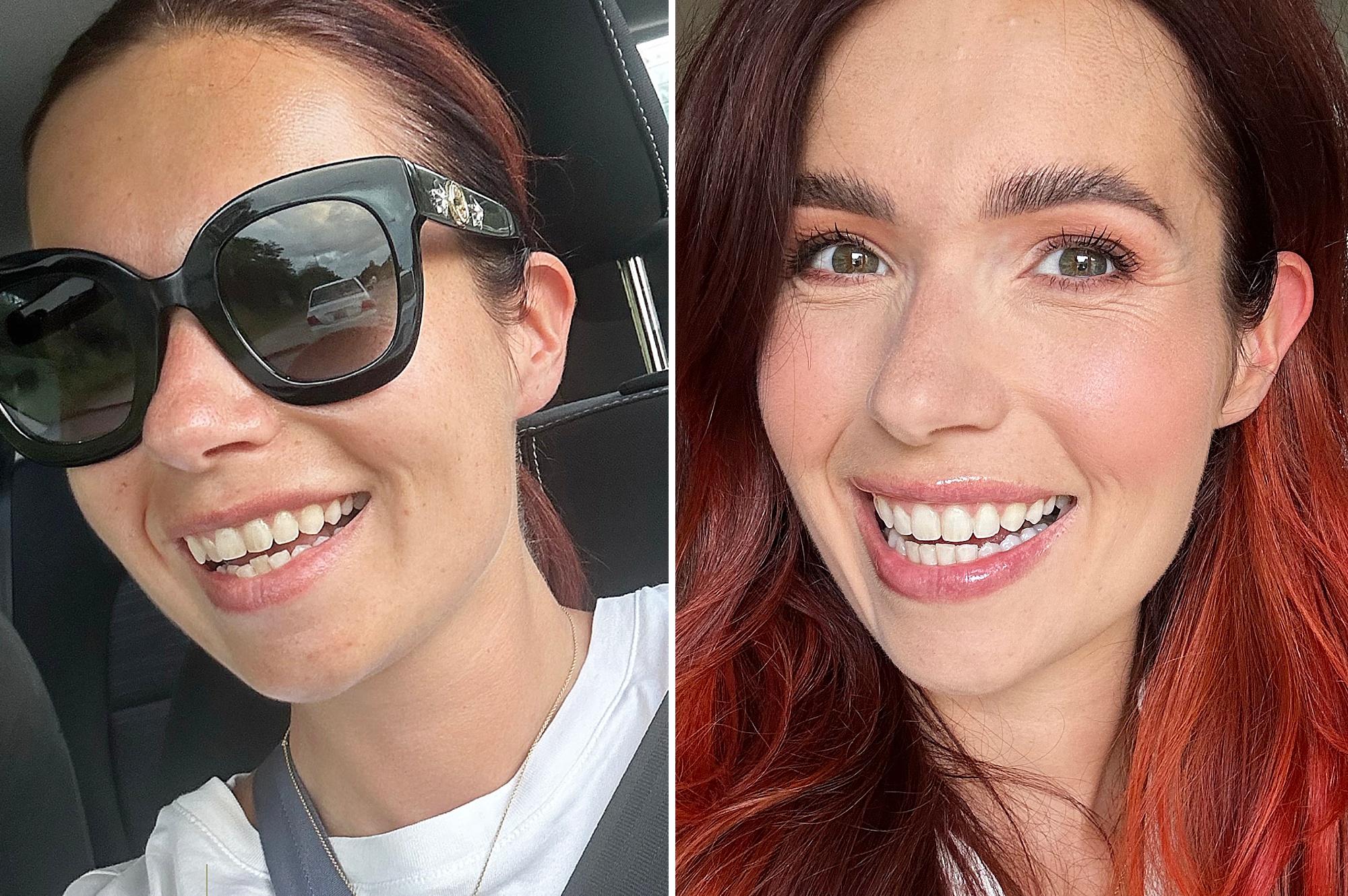 Meest gestelde vragen over Invisalign • Cynthia